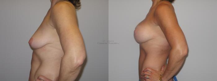 Before & After Breast Lift Case 25 View #2 View in St. Louis, MO