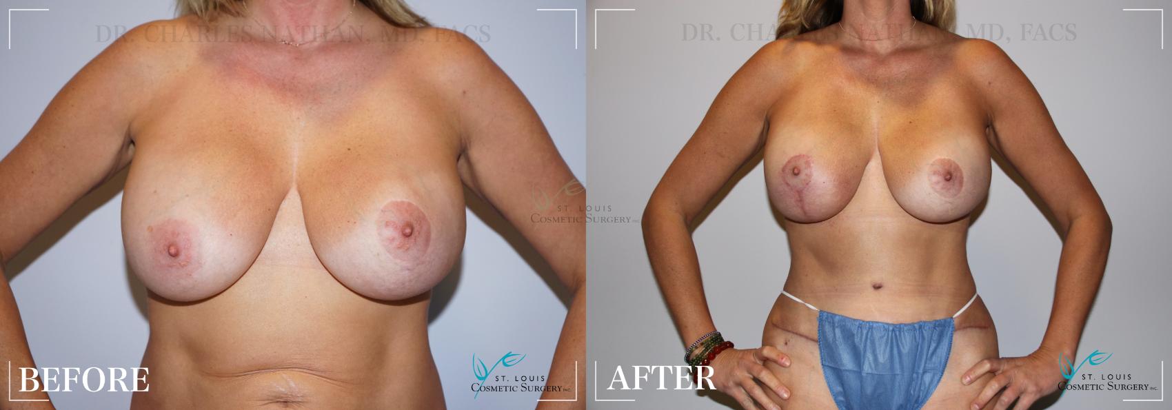 Before & After Breast Lift Case 251 Front View in St. Louis, MO