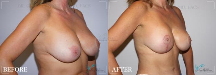 Before & After Breast Lift Case 251 Right Oblique View in St. Louis, MO