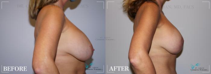 Before & After Breast Lift Case 251 Right Side View in St. Louis, MO