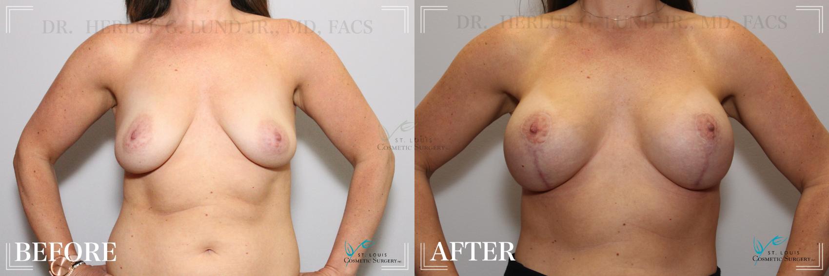 Before & After Breast Lift Case 262 Front View in St. Louis, MO