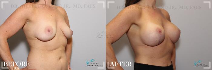 Before & After Breast Lift Case 262 Right Oblique View in St. Louis, MO