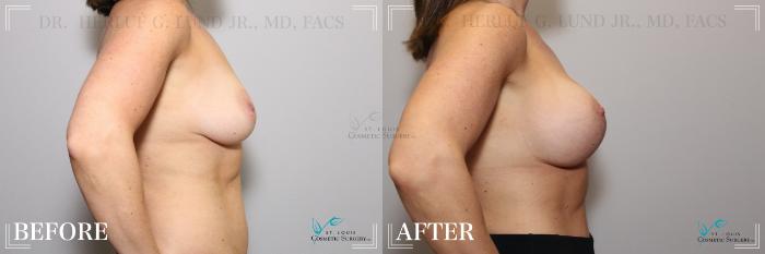 Before & After Breast Lift Case 262 Right Side View in St. Louis, MO