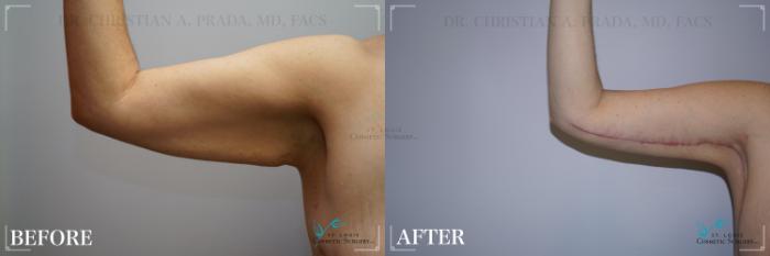 Before & After Tummy Tuck Case 271 Arm- Bent View in St. Louis, MO