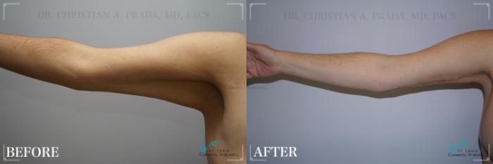 Before & After Tummy Tuck Case 271 Arm- Straight  View in St. Louis, MO