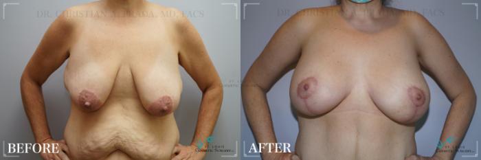 Before & After Breast Lift Case 271 Front- Breasts View in St. Louis, MO