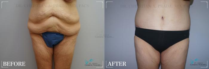 Before & After Tummy Tuck Case 271 Front View in St. Louis, MO