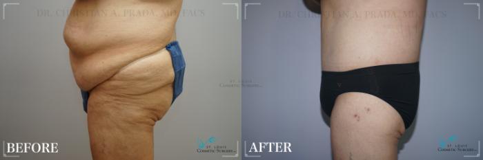Before & After Tummy Tuck Case 271 Right Side View in St. Louis, MO
