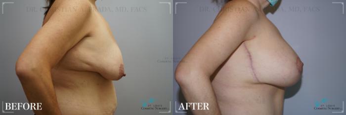 Before & After Breast Lift Case 271 Side- Breasts View in St. Louis, MO