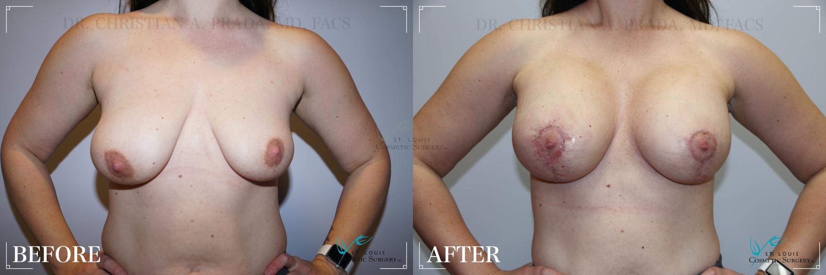 Before & After Breast Lift Case 272 Front View in St. Louis, MO