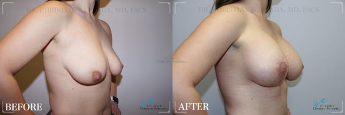 Before & After Breast Augmentation Case 272 Right Oblique View in St. Louis, MO
