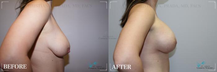 Before & After Breast Lift Case 272 Right Side View in St. Louis, MO