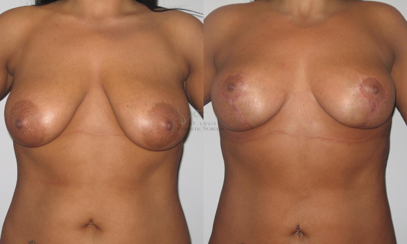 Before & After Breast Lift Case 28 View #1 View in St. Louis, MO