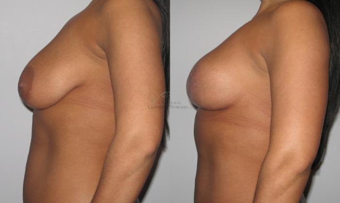 Before & After Breast Lift Case 28 View #2 View in St. Louis, MO