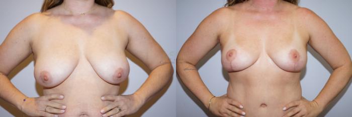Before & After Breast Lift Case 292 Front View in St. Louis, MO