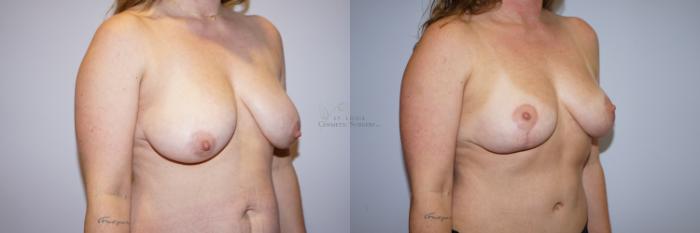 Before & After Breast Lift Case 292 Left Oblique View in St. Louis, MO