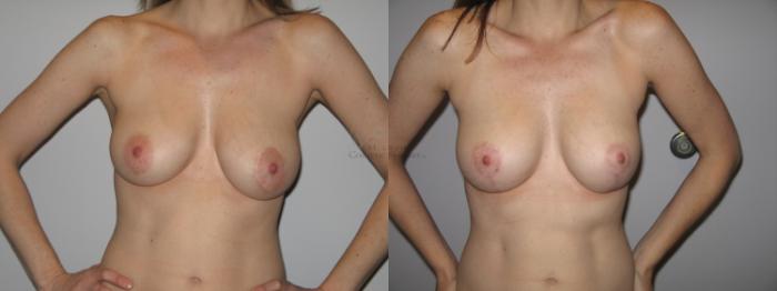 Before & After Breast Lift Case 34 View #1 View in St. Louis, MO