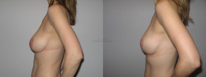 Before & After Breast Lift Case 34 View #2 View in St. Louis, MO