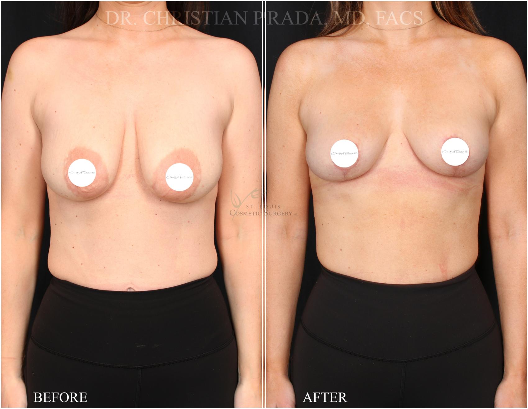 Before & After Breast Lift Case 368 Front View in St. Louis, MO