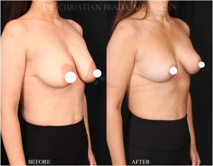 Before & After Breast Lift Case 368 Left Oblique View in St. Louis, MO