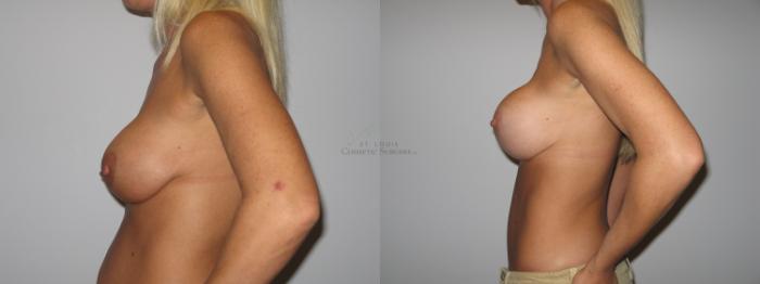 Before & After Breast Lift Case 38 View #2 View in St. Louis, MO