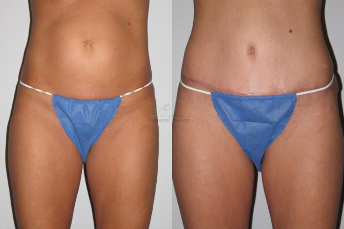 Before & After Breast Lift Case 38 View #3 View in St. Louis, MO