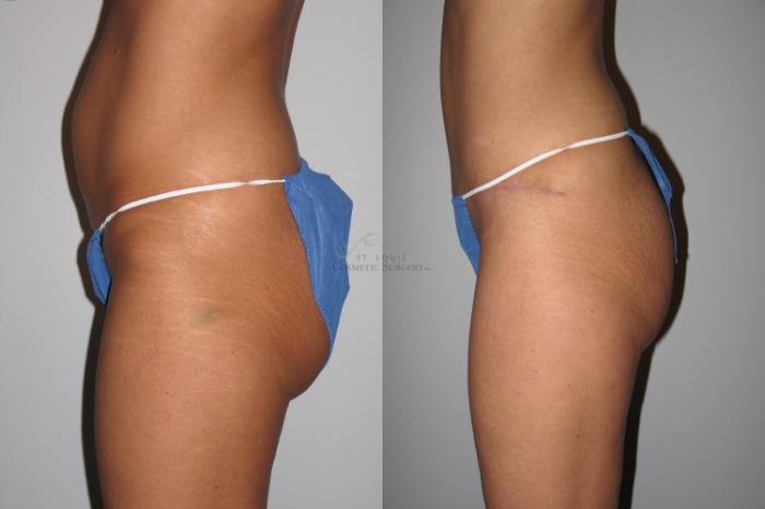 Before & After Breast Lift Case 38 View #4 View in St. Louis, MO