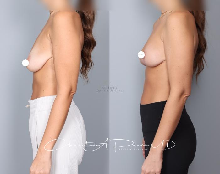 Before & After Breast Lift Case 401 Left Side View in St. Louis, MO