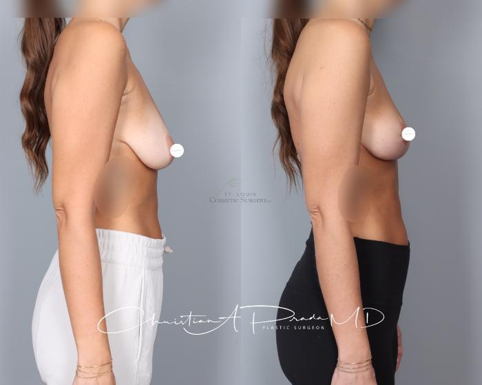 Before & After Breast Lift Case 401 Right Side View in St. Louis, MO