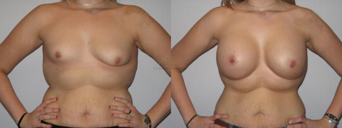 Before & After Breast Lift Case 42 View #1 View in St. Louis, MO