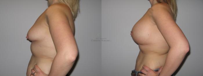 Before & After Breast Lift Case 42 View #2 View in St. Louis, MO