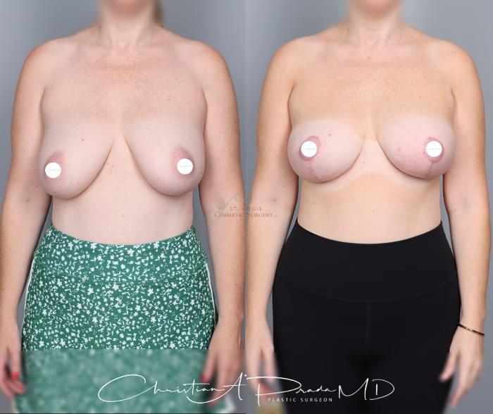 Before & After Breast Lift Case 427 Front View in St. Louis, MO
