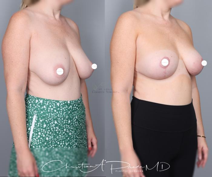 Before & After Breast Lift Case 427 Left Oblique View in St. Louis, MO