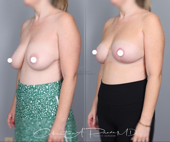 Before & After Breast Lift Case 427 Right Oblique View in St. Louis, MO