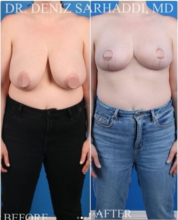 Before & After Breast Lift Case 428 Front View in St. Louis, MO