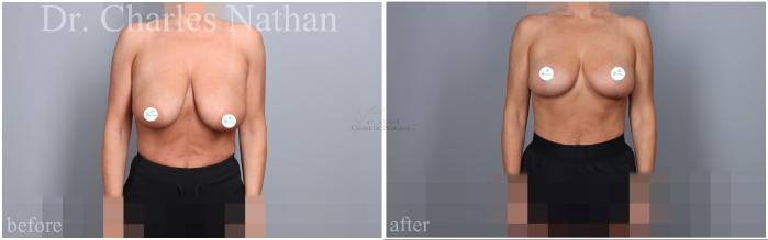 Before & After Breast Lift Case 459 Front View in St. Louis, MO
