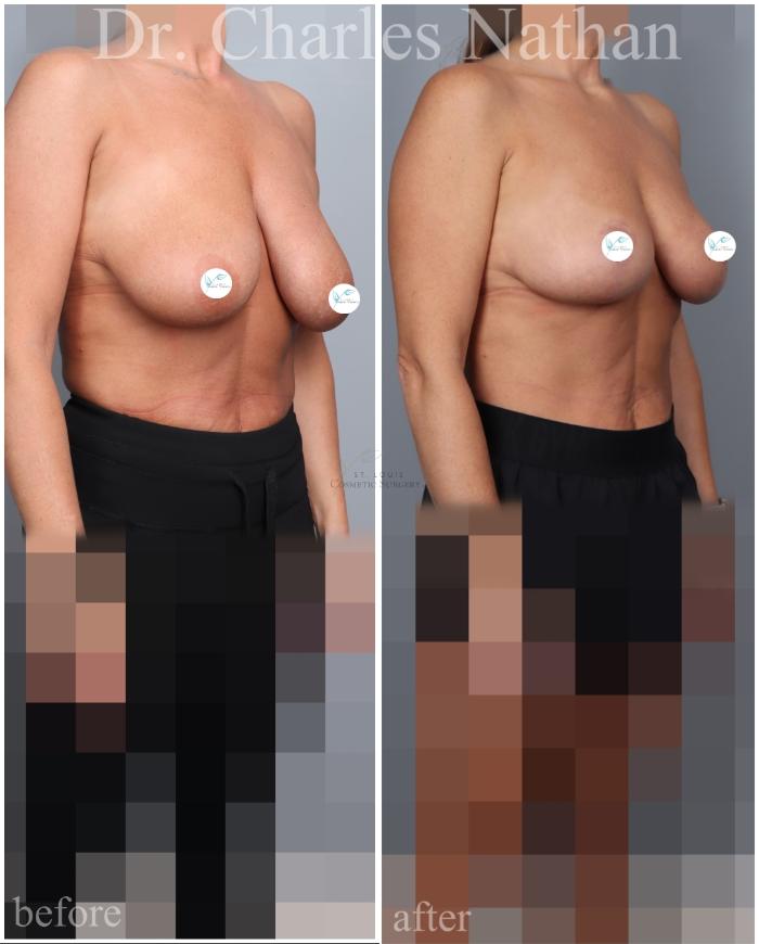 Before & After Breast Lift Case 459 Right Oblique View in St. Louis, MO