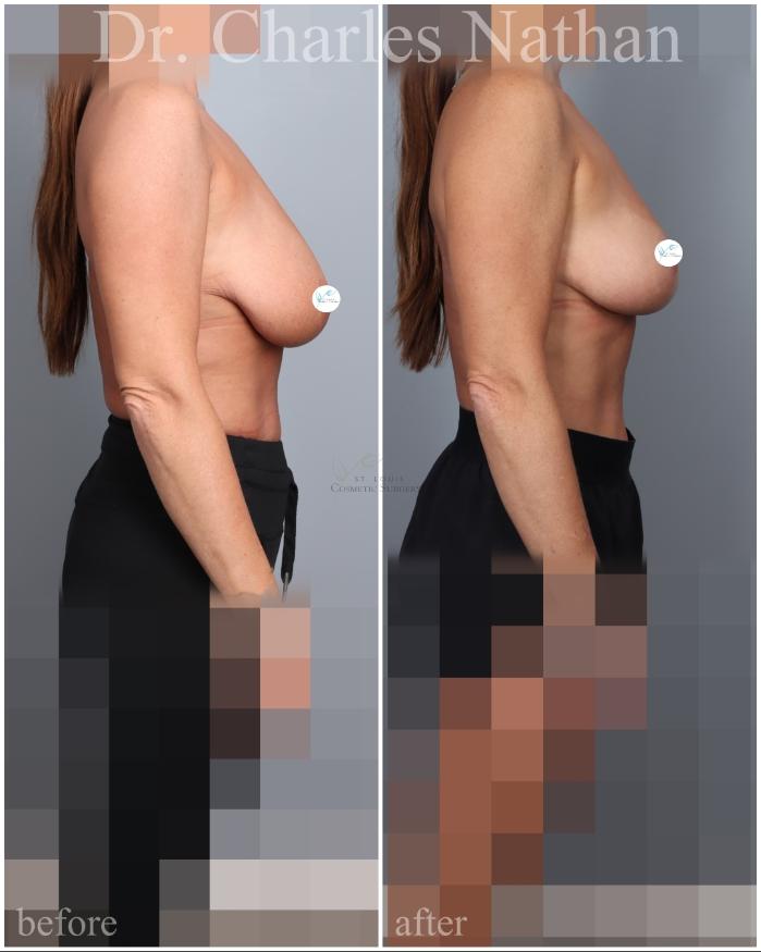 Before & After Breast Lift Case 459 Right Side View in St. Louis, MO