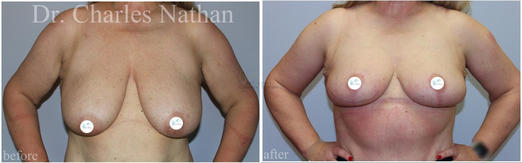 Before & After Breast Lift Case 461 Front View in St. Louis, MO
