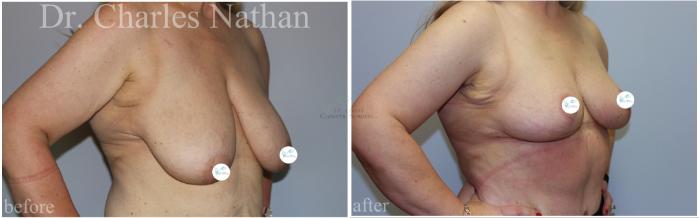 Before & After Breast Lift Case 461 Right Oblique View in St. Louis, MO