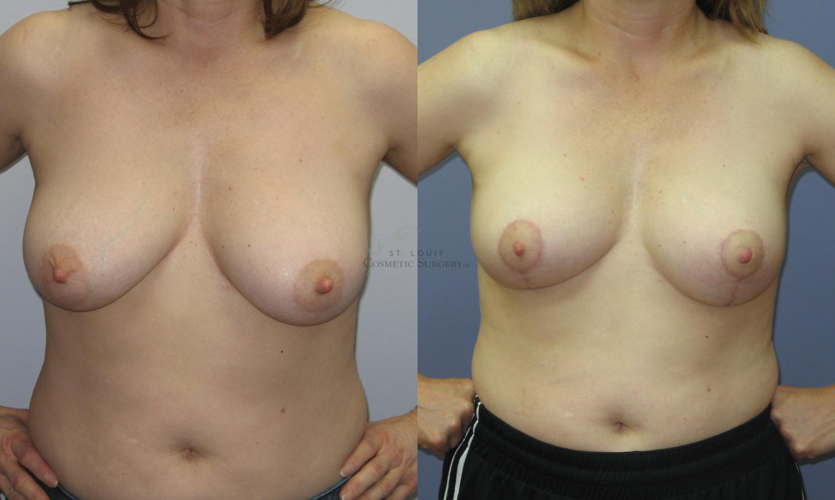 Before & After Breast Lift Case 55 View #1 View in St. Louis, MO