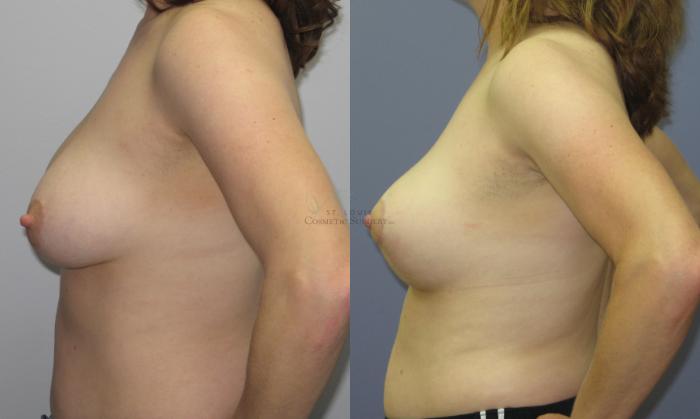 Before & After Breast Lift Case 55 View #2 View in St. Louis, MO