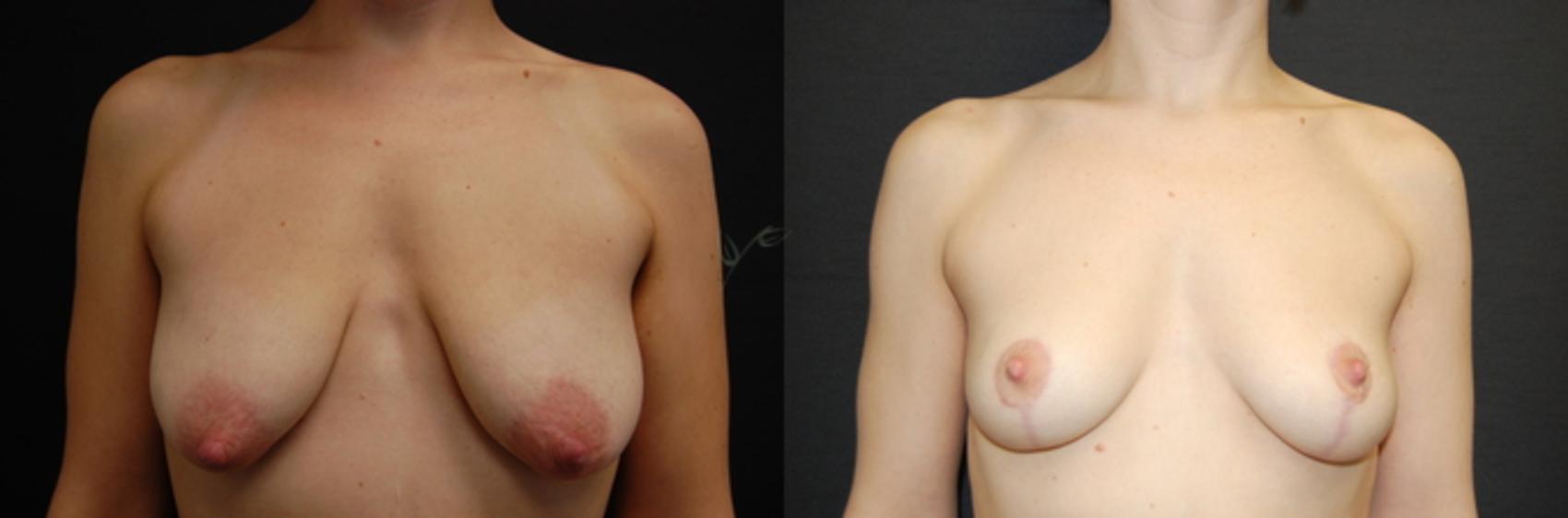 Before & After Breast Lift Case 60 View #1 View in St. Louis, MO