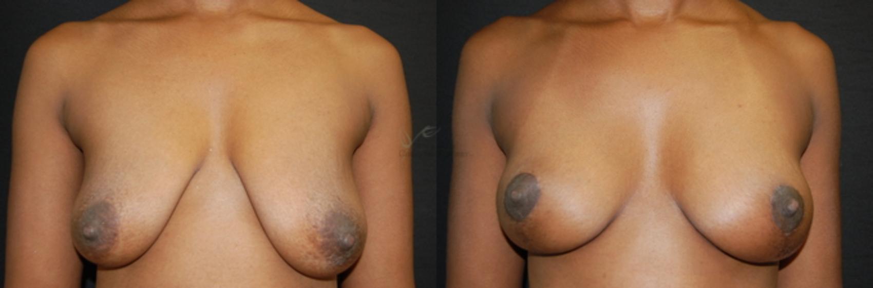 Before & After Breast Lift Case 61 View #1 View in St. Louis, MO