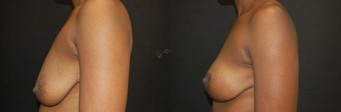 Before & After Breast Lift Case 61 View #2 View in St. Louis, MO