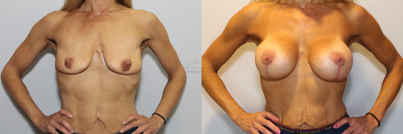 Before & After Breast Lift Case 78 View #1 View in St. Louis, MO
