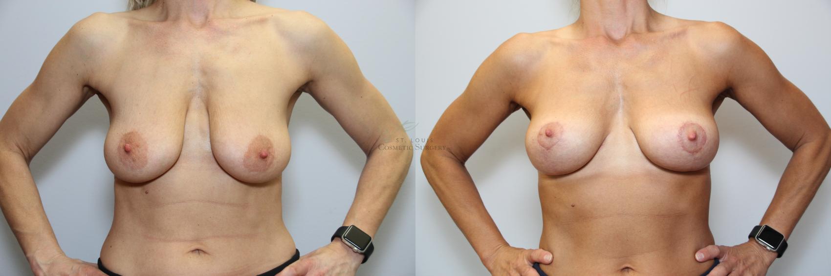 Before & After Breast Lift Case 92 View #1 View in St. Louis, MO