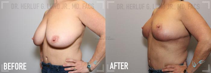 Before & After Breast Reduction Case 145 Left Oblique View in St. Louis, MO