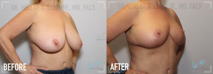 Before & After Breast Reduction Case 145 Right Oblique View in St. Louis, MO