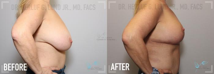 Before & After Breast Reduction Case 145 Right Side View in St. Louis, MO